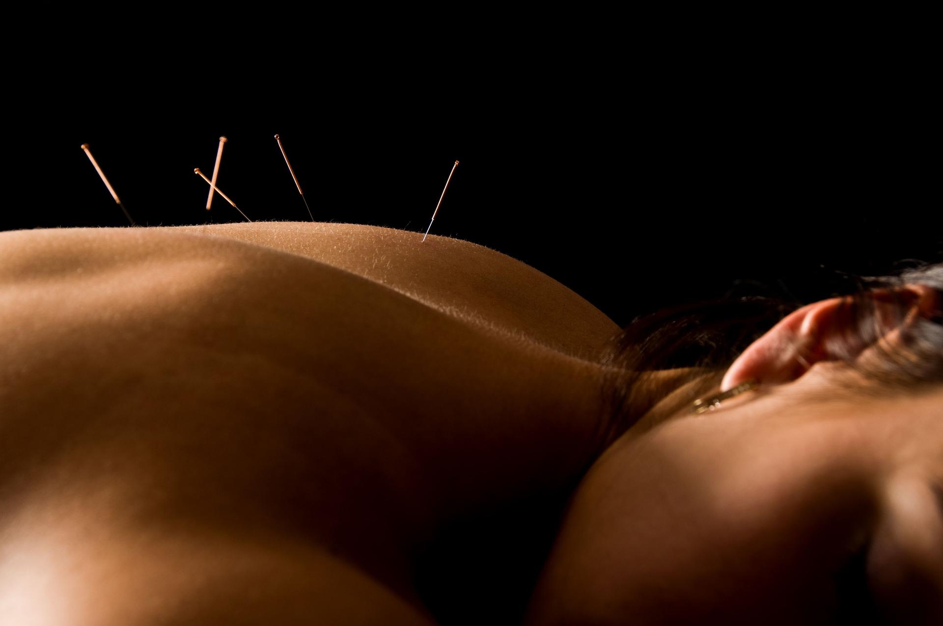 Acupuntura